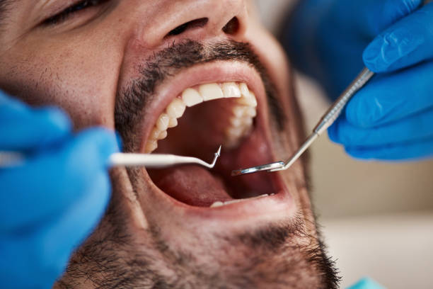 Best Emergency Tooth Extraction in Farmersville, CA