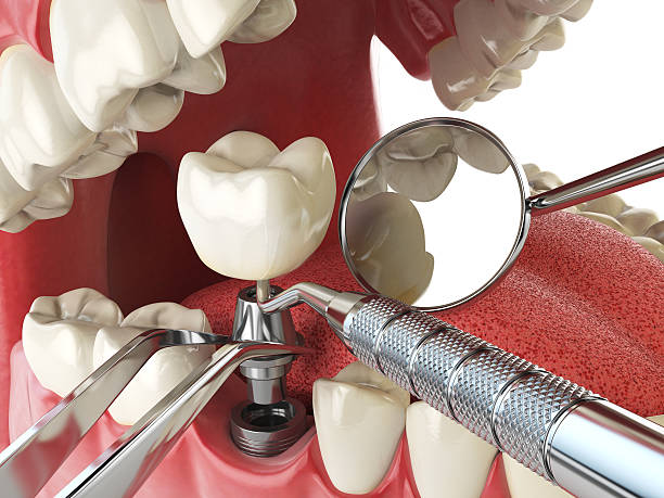 Best Emergency Dental Care for Broken or Chipped Teeth in Farmersville, CA