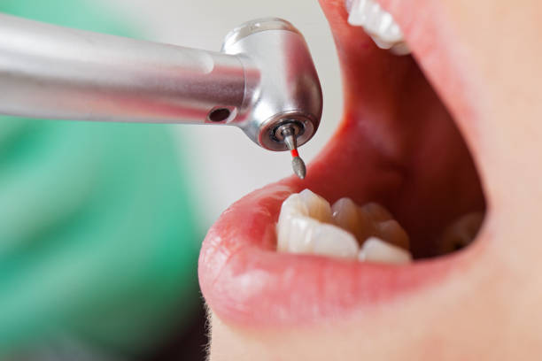 Best Emergency Root Canal Treatment in Farmersville, CA